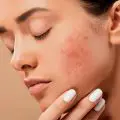 huile nigelle acne utilisation